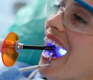 Dental Fillings