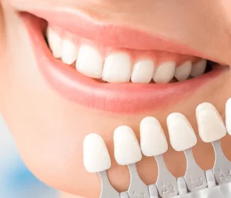 Dental Veneers